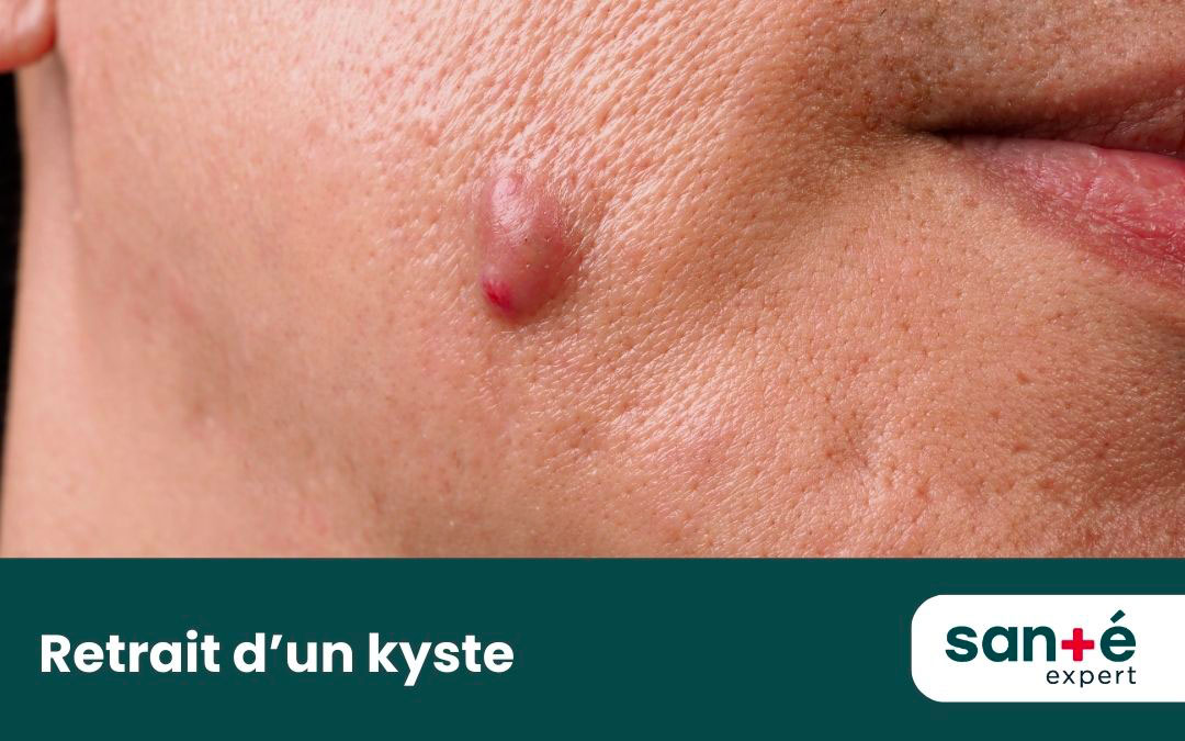 Chirurgie Mineure De Kyste Qu bec Sant Expert Chirurgie Mineure De Kyste Qu bec Sant Expert