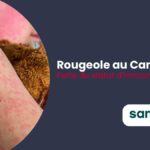 Perte du statut d’élimination de la rougeole au Canada