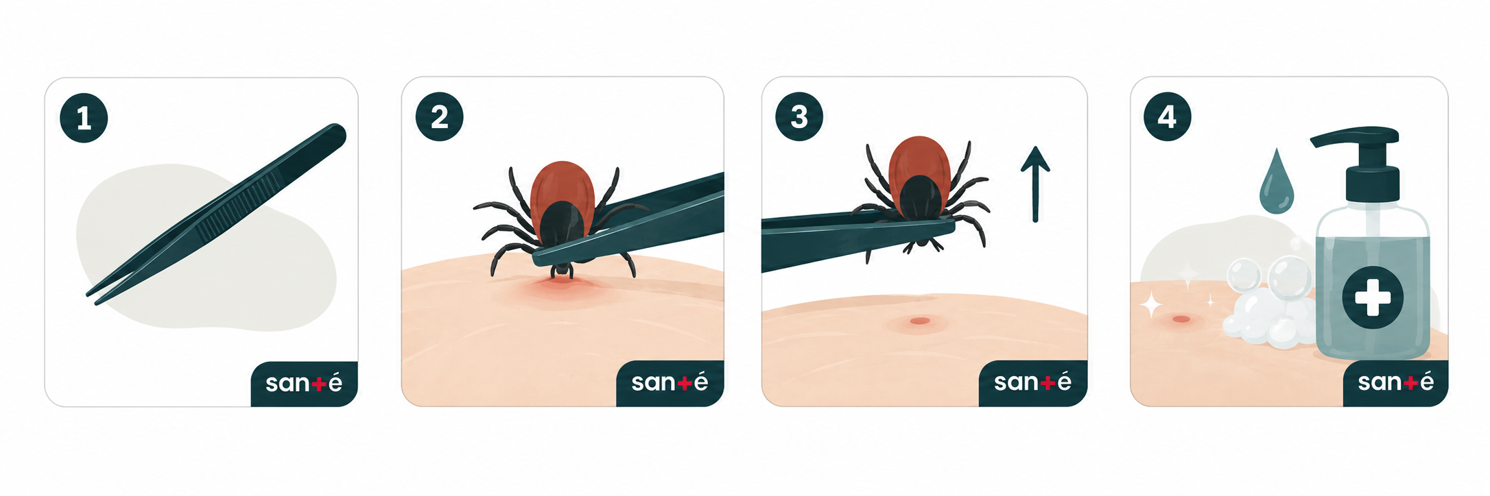 Illustration montrant les 4 étapes pour retirer correctement une tique avec une pince à pointe fine afin de réduire le risque de maladie de Lyme.